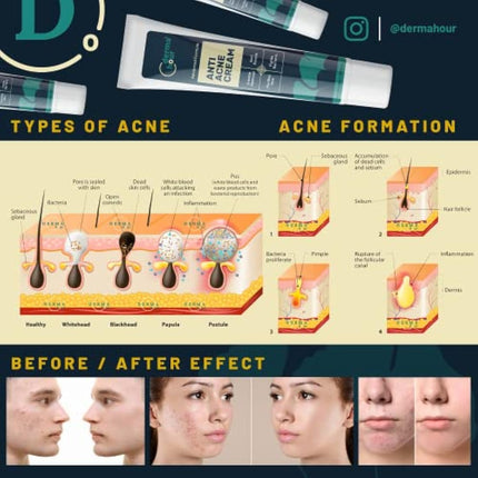 DermaHour Powerful Anti Acne Removal Cream - Targets Pimples, Spots, Skin Tags, and Ingrown Hair - Balances Water and Oil - Skincare Moisturizer with Ginkgo Biloba Extract - 40ml